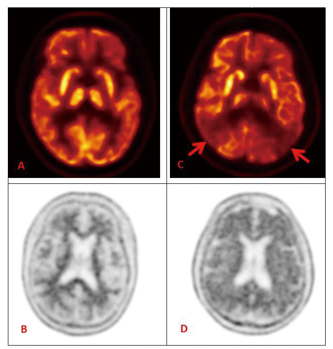 腦部正子斷層造影搭配不同造影劑在失智症診斷之應用